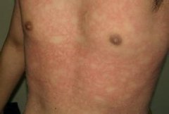 玫瑰糠疹早期有哪些症状？